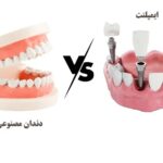مزایای ایمپلنت دندان در مقایسه با دندان مصنوعی2