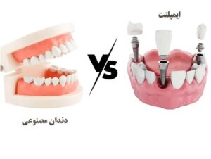 مزایای ایمپلنت دندان در مقایسه با دندان مصنوعی2