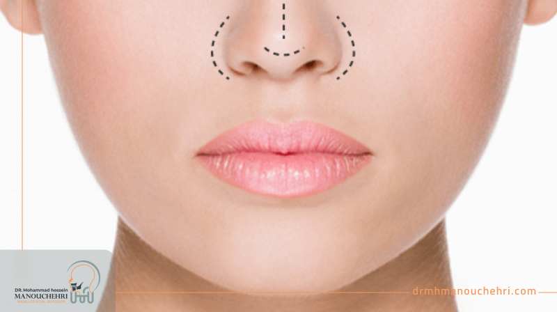 جراحی بینی در اصفهان دکتر محمد حسین کموچهری